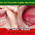 Kista Mulut, Ini Penyebab, Gejala, dan Penanganannya