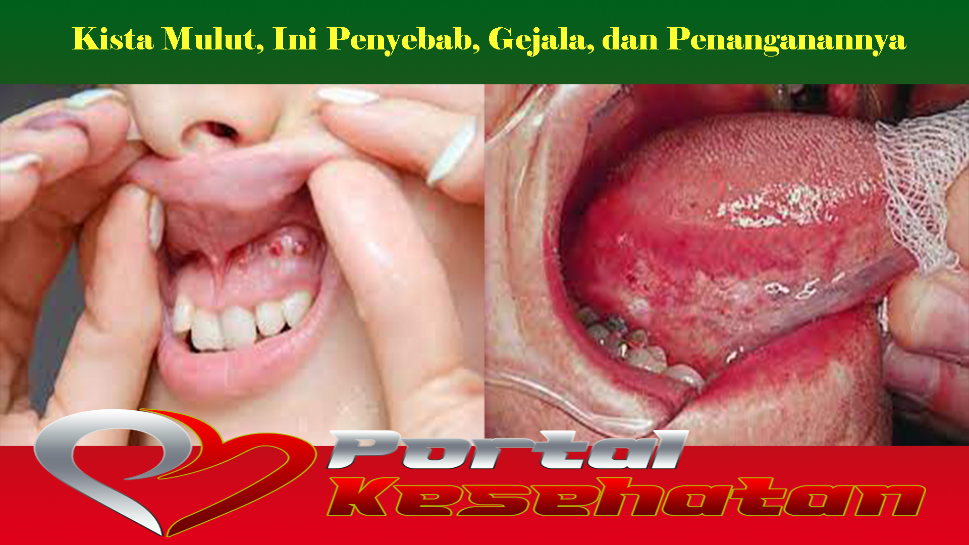 Kista Mulut, Ini Penyebab, Gejala, dan Penanganannya