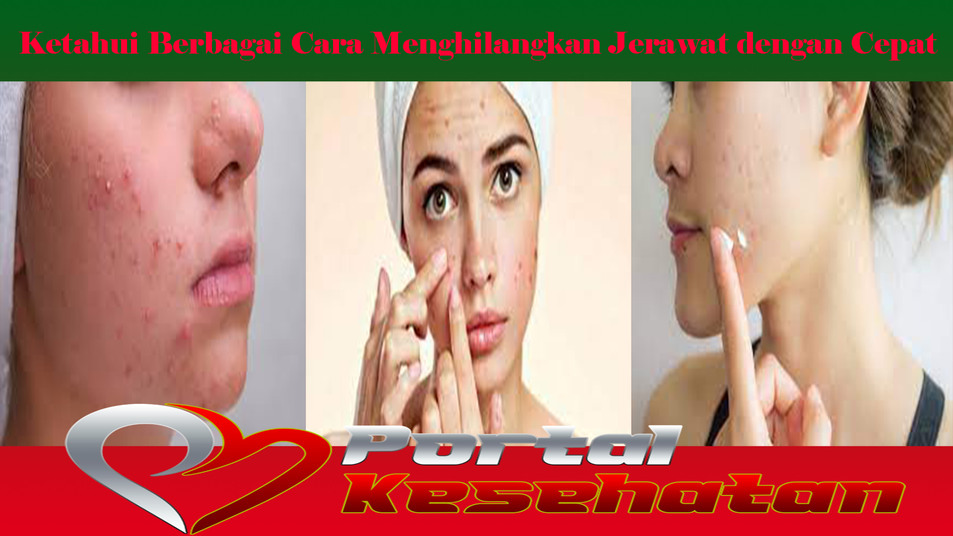 Ketahui Berbagai Cara Menghilangkan Jerawat dengan Cepat