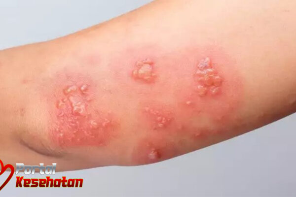 10 Obat Herpes Alami untuk Redakan Gejalanya