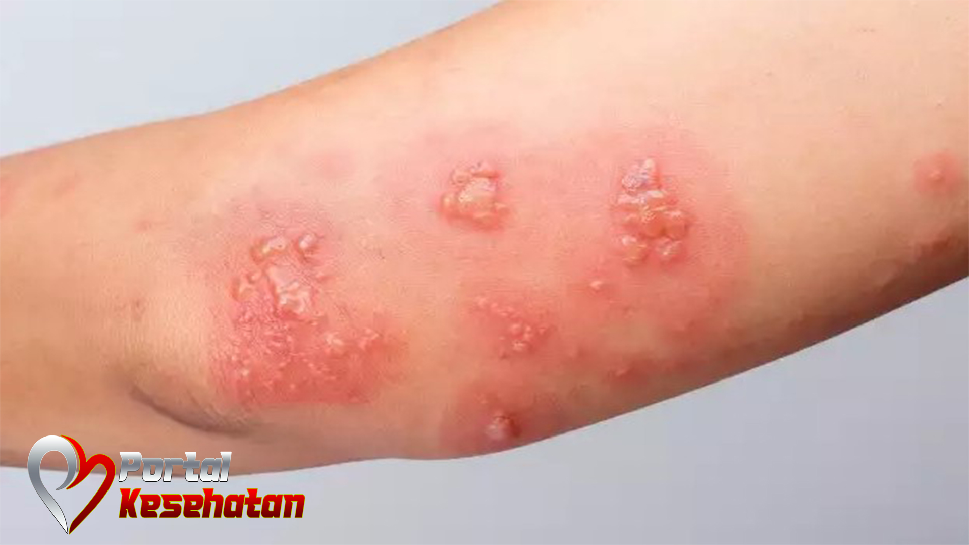 10 Obat Herpes Alami untuk Redakan Gejalanya