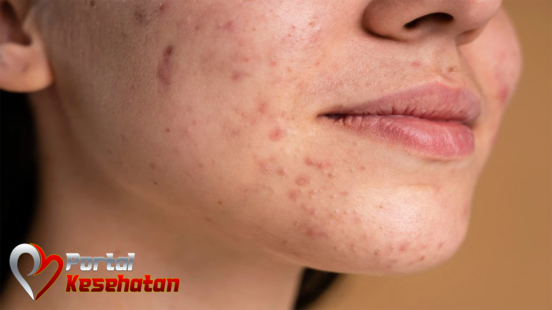 Ketahui Berbagai Cara Menghilangkan Jerawat dengan Cepat