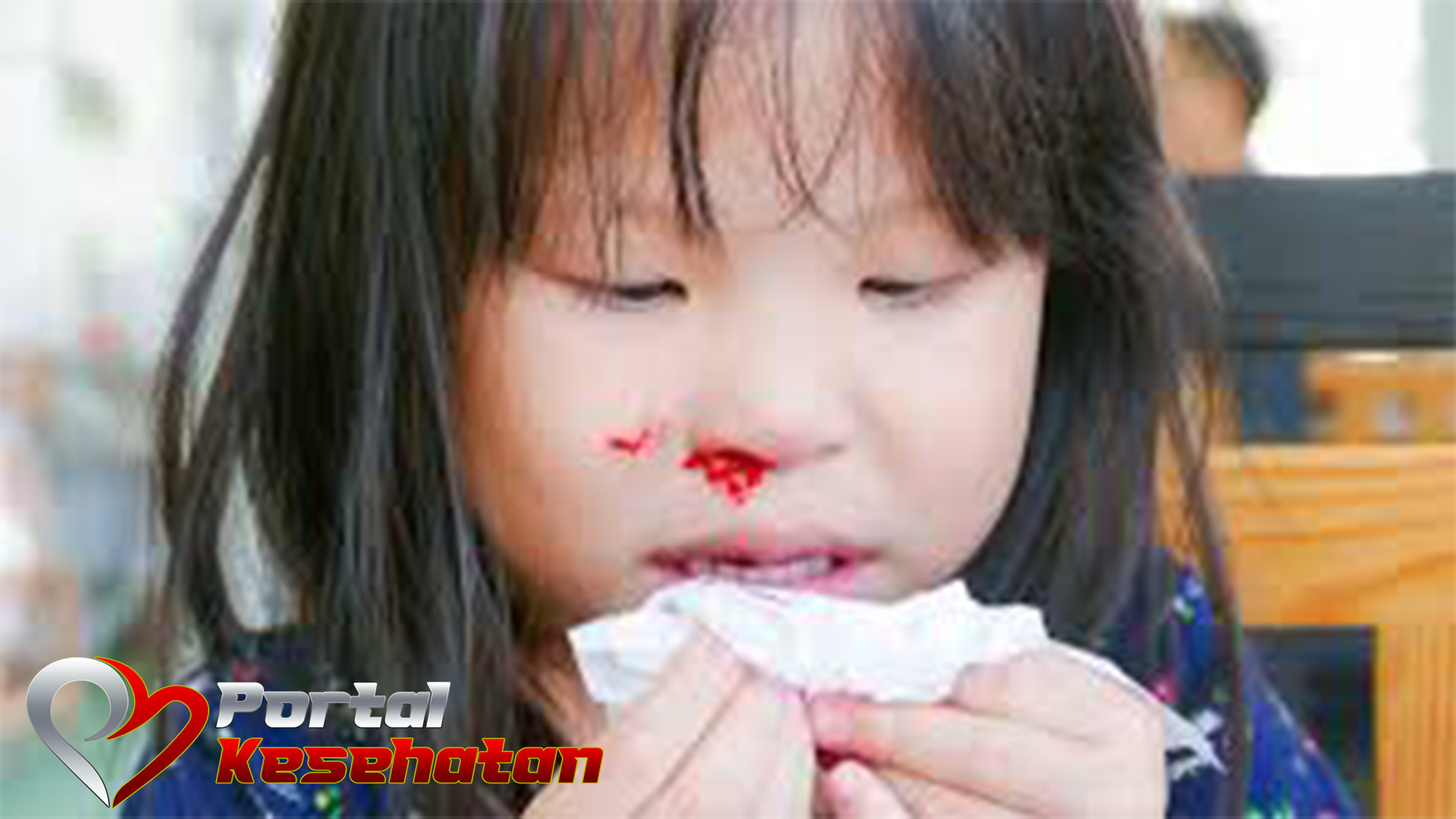 Penyebab mimisan pada anak dan cara mengatasinya