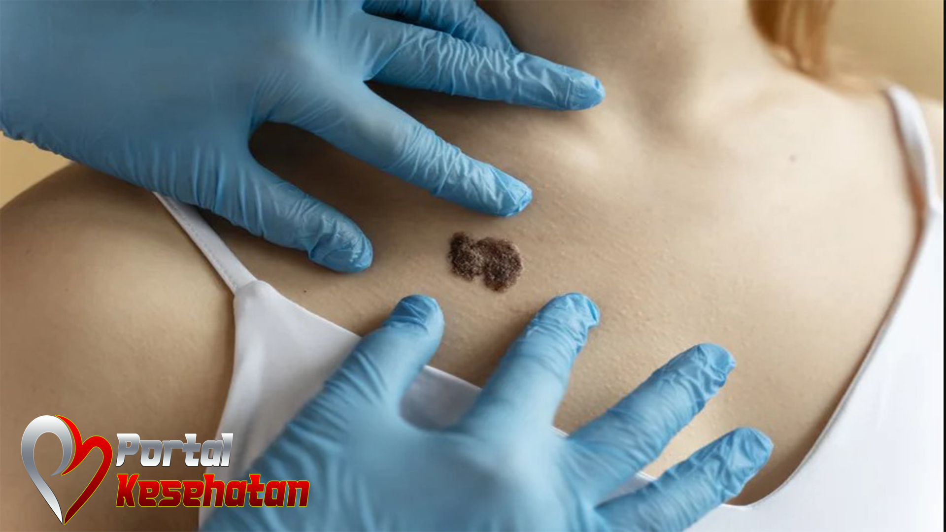Prosedur Medis untuk Operasi Tahi Lalat yang Mengganggu
