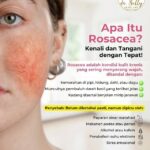 Waspadai Ciri-ciri Rosacea: Kulit Merah-merah