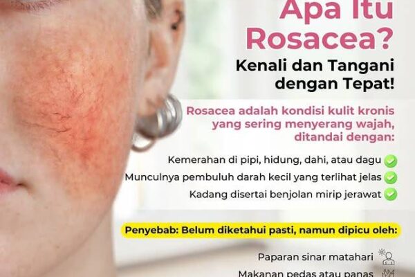 Waspadai Ciri-ciri Rosacea: Kulit Merah-merah Waspadai Ciri-ciri Rosacea: Kulit Merah-merah